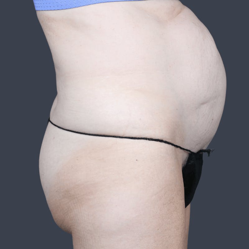 Abdominoplasty / Tummy Tuck Before & After Gallery - Patient 136756 - Image 5