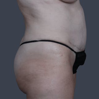Abdominoplasty / Tummy Tuck Before & After Gallery - Patient 136756 - Image 6