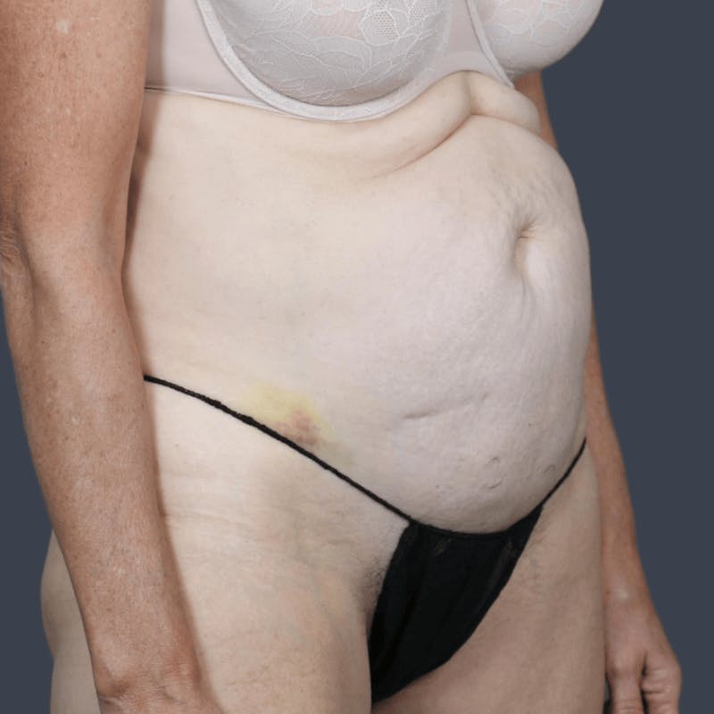 Abdominoplasty / Tummy Tuck Before & After Gallery - Patient 136756 - Image 3