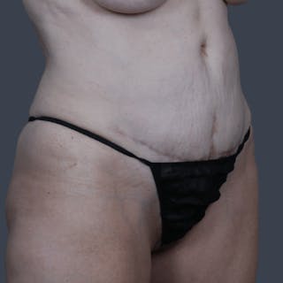 Abdominoplasty / Tummy Tuck Before & After Gallery - Patient 136756 - Image 4