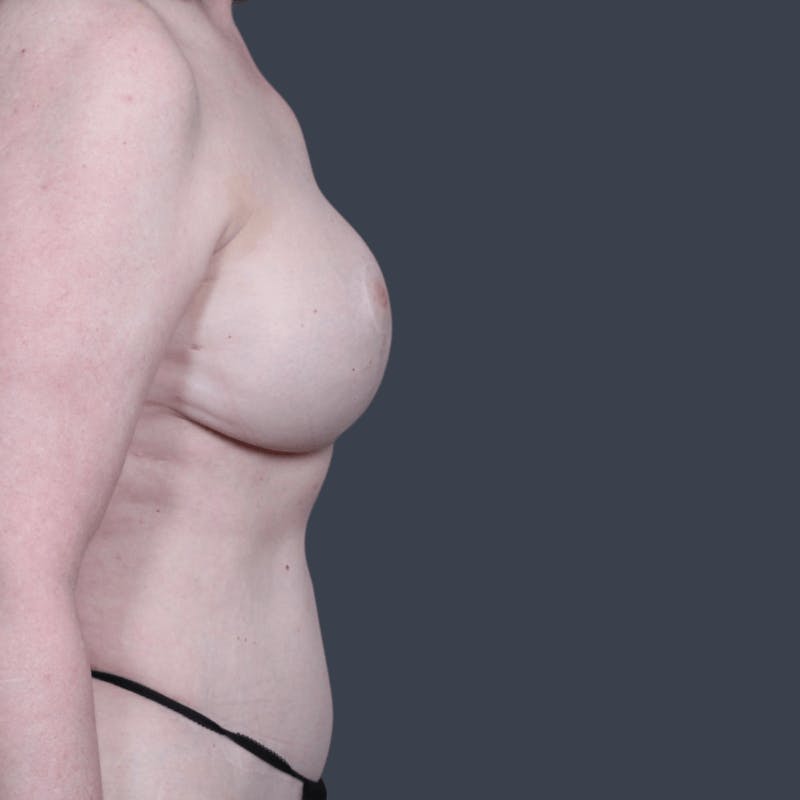 Liposuction Before & After Gallery - Patient 240890 - Image 6