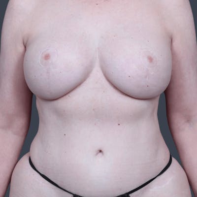 Liposuction Before & After Gallery - Patient 240890 - Image 2
