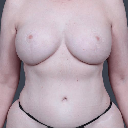 After procedure image for Liposuction