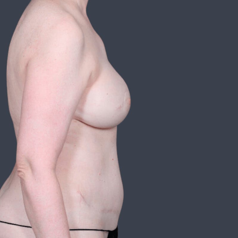 Liposuction Before & After Gallery - Patient 240890 - Image 5