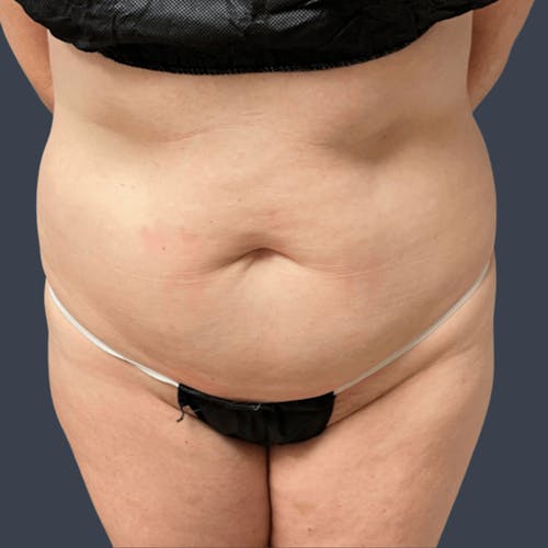 Before procedure image for Liposuction