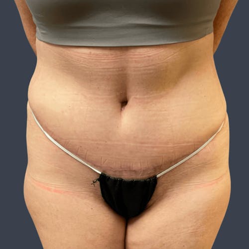 After procedure image for Liposuction
