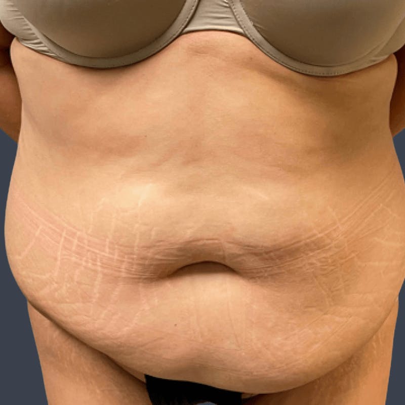 Abdominoplasty / Tummy Tuck Before & After Gallery - Patient 419638 - Image 1
