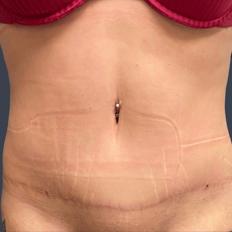 Abdominoplasty / Tummy Tuck Before & After Gallery - Patient 419638 - Image 2
