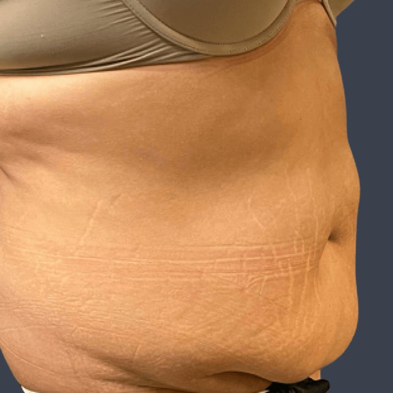 Abdominoplasty / Tummy Tuck Before & After Gallery - Patient 419638 - Image 3