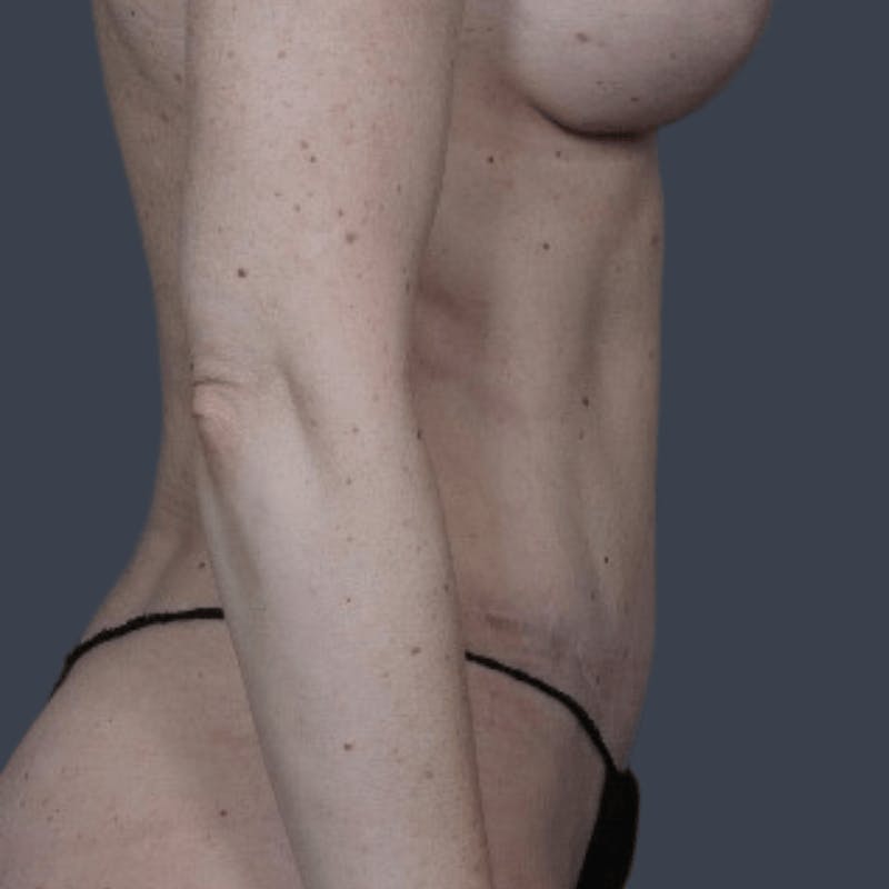 Mommy Makeover Before & After Gallery - Patient 362859 - Image 6