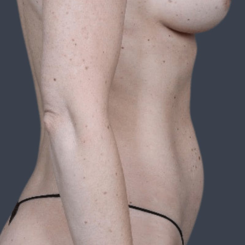 Mommy Makeover Before & After Gallery - Patient 362859 - Image 5
