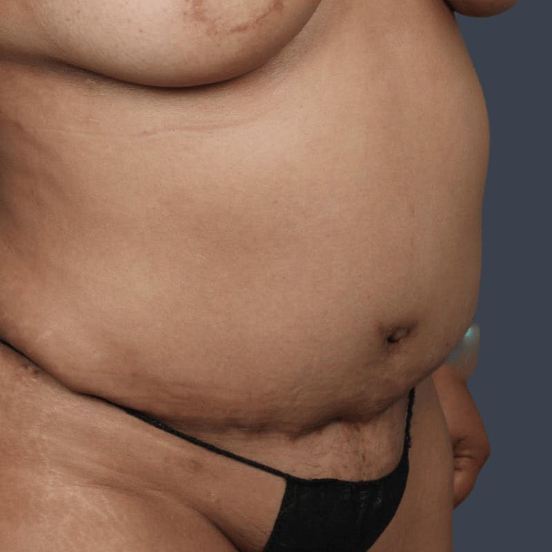 Abdominoplasty / Tummy Tuck Before & After Gallery - Patient 408182 - Image 3
