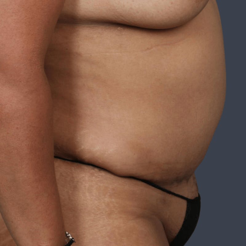Abdominoplasty / Tummy Tuck Before & After Gallery - Patient 408182 - Image 5