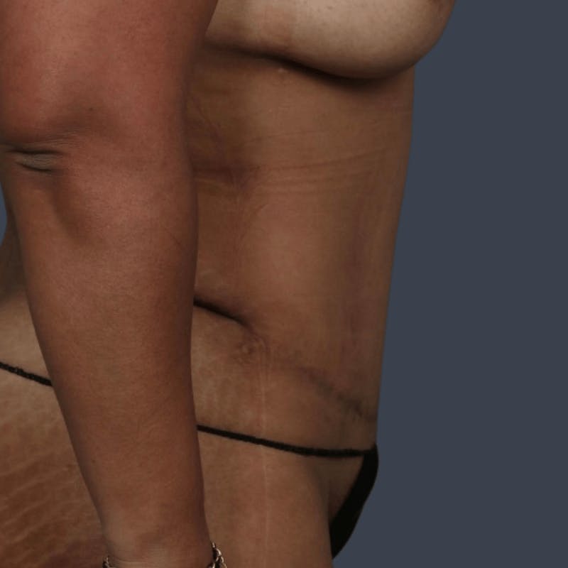 Abdominoplasty / Tummy Tuck Before & After Gallery - Patient 408182 - Image 6