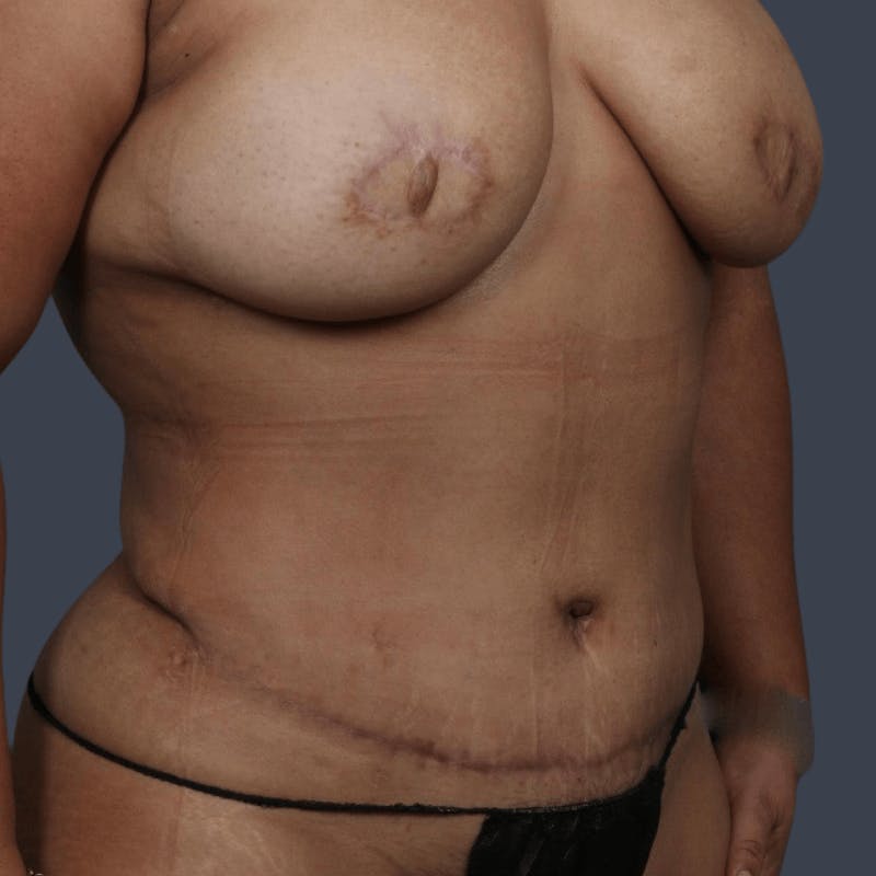 Abdominoplasty / Tummy Tuck Before & After Gallery - Patient 408182 - Image 4