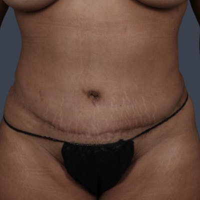 Liposuction Before & After Gallery - Patient 461833 - Image 2