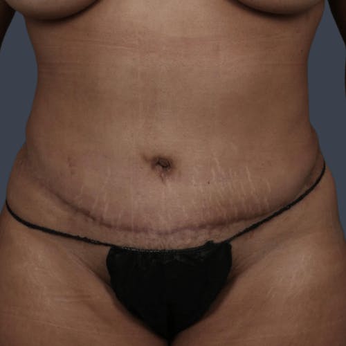 After procedure image for Liposuction