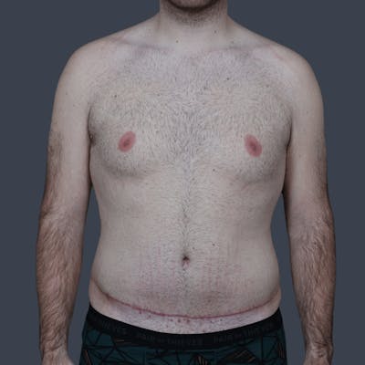 Liposuction Before & After Gallery - Patient 224178 - Image 2