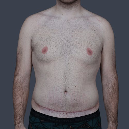 After procedure image for Liposuction