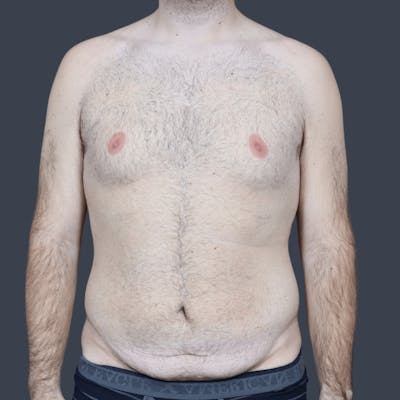 Liposuction Before & After Gallery - Patient 224178 - Image 1