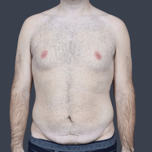 Before procedure image for Liposuction