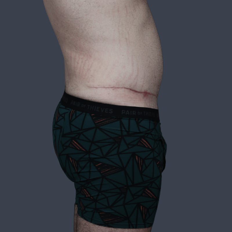 Liposuction Before & After Gallery - Patient 224178 - Image 6