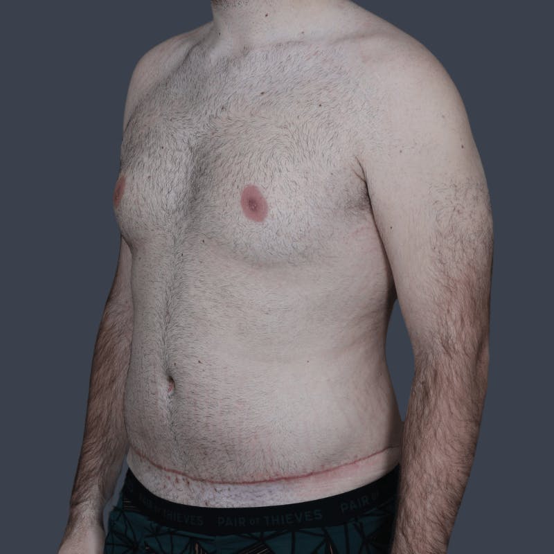 Liposuction Before & After Gallery - Patient 224178 - Image 4