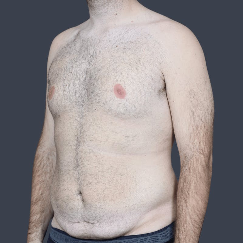 Liposuction Before & After Gallery - Patient 224178 - Image 3