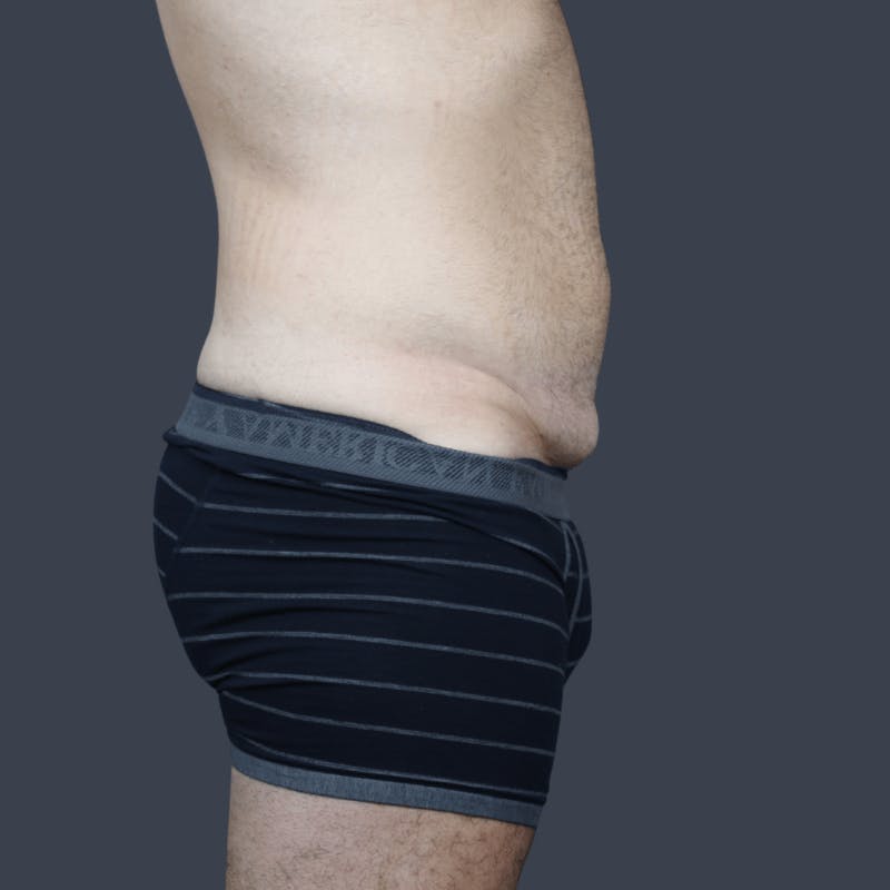 Liposuction Before & After Gallery - Patient 224178 - Image 5