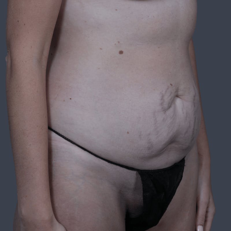 Abdominoplasty / Tummy Tuck Before & After Gallery - Patient 251853 - Image 3