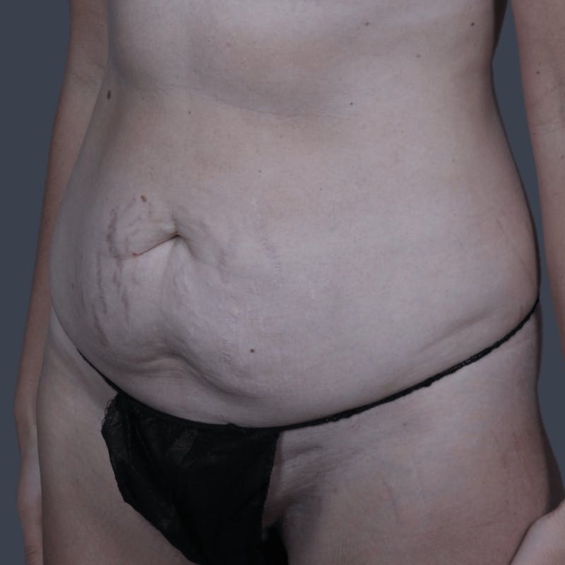 Abdominoplasty / Tummy Tuck Before & After Gallery - Patient 251853 - Image 5