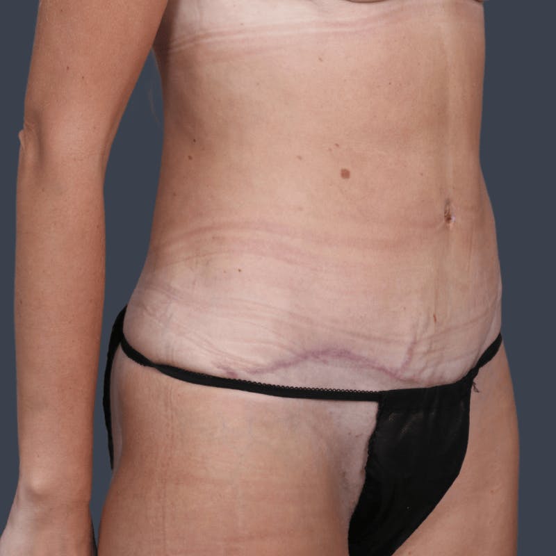 Abdominoplasty / Tummy Tuck Before & After Gallery - Patient 251853 - Image 4