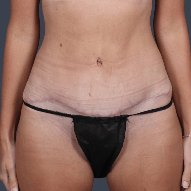 Abdominoplasty / Tummy Tuck Before & After Gallery - Patient 251853 - Image 2