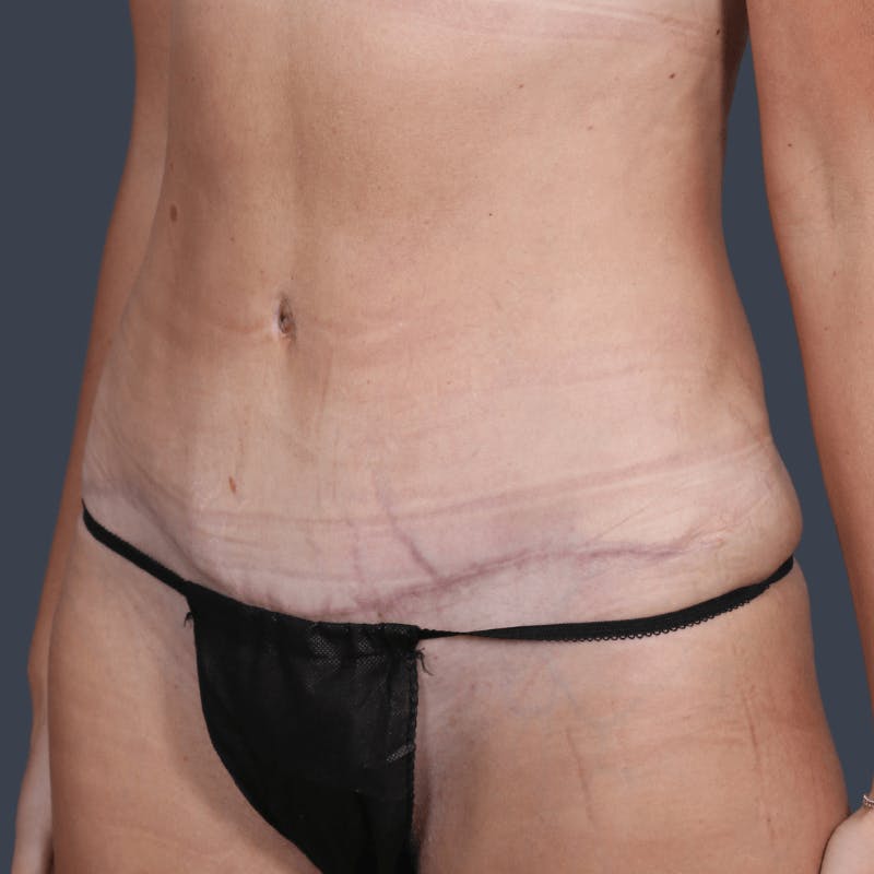 Abdominoplasty / Tummy Tuck Before & After Gallery - Patient 251853 - Image 6