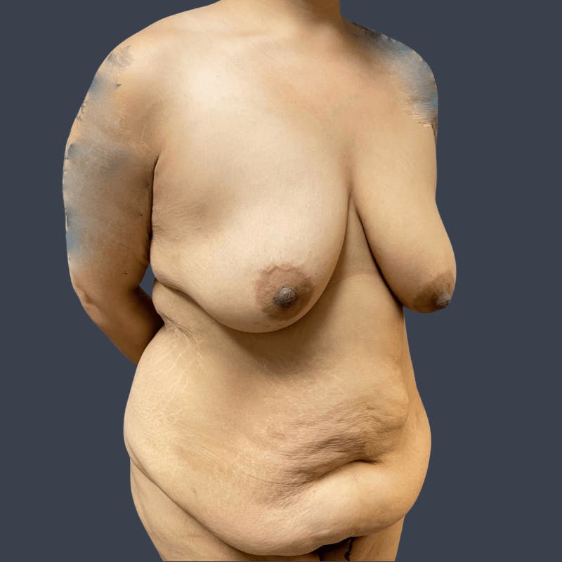Abdominoplasty / Tummy Tuck Before & After Gallery - Patient 396856 - Image 3