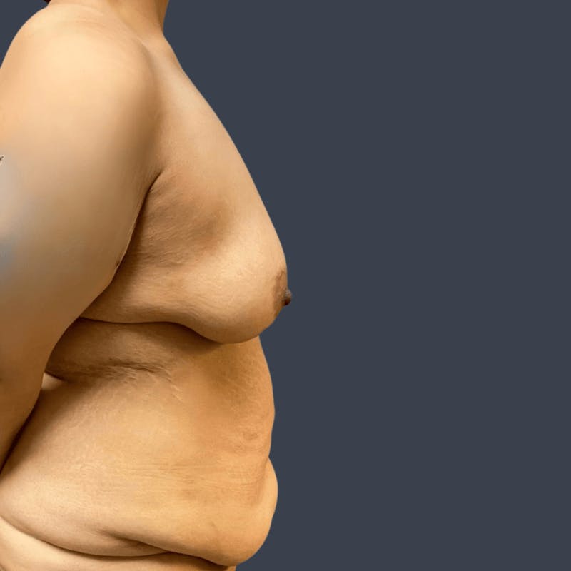 Abdominoplasty / Tummy Tuck Before & After Gallery - Patient 396856 - Image 5