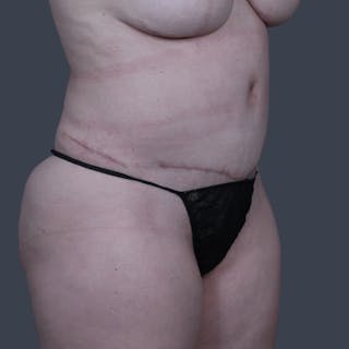 Abdominoplasty / Tummy Tuck Before & After Gallery - Patient 215261 - Image 4