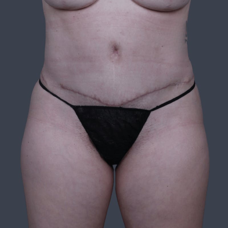 Abdominoplasty / Tummy Tuck Before & After Gallery - Patient 215261 - Image 2