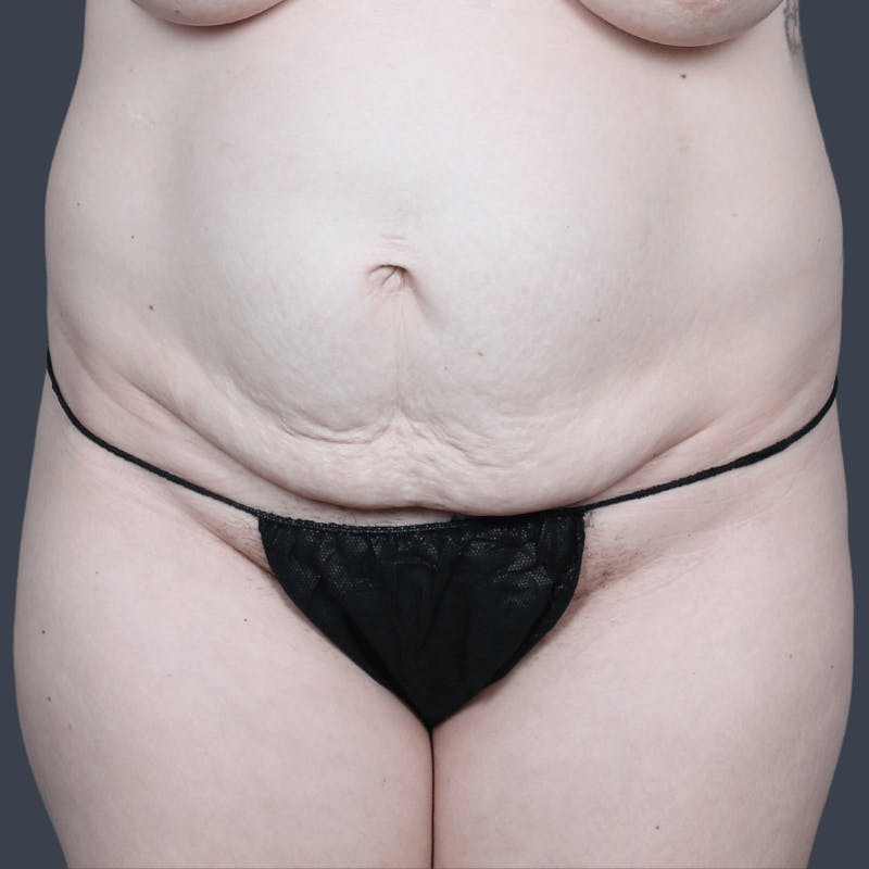 Abdominoplasty / Tummy Tuck Before & After Gallery - Patient 215261 - Image 1