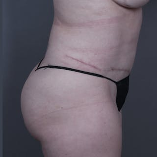 Abdominoplasty / Tummy Tuck Before & After Gallery - Patient 215261 - Image 6