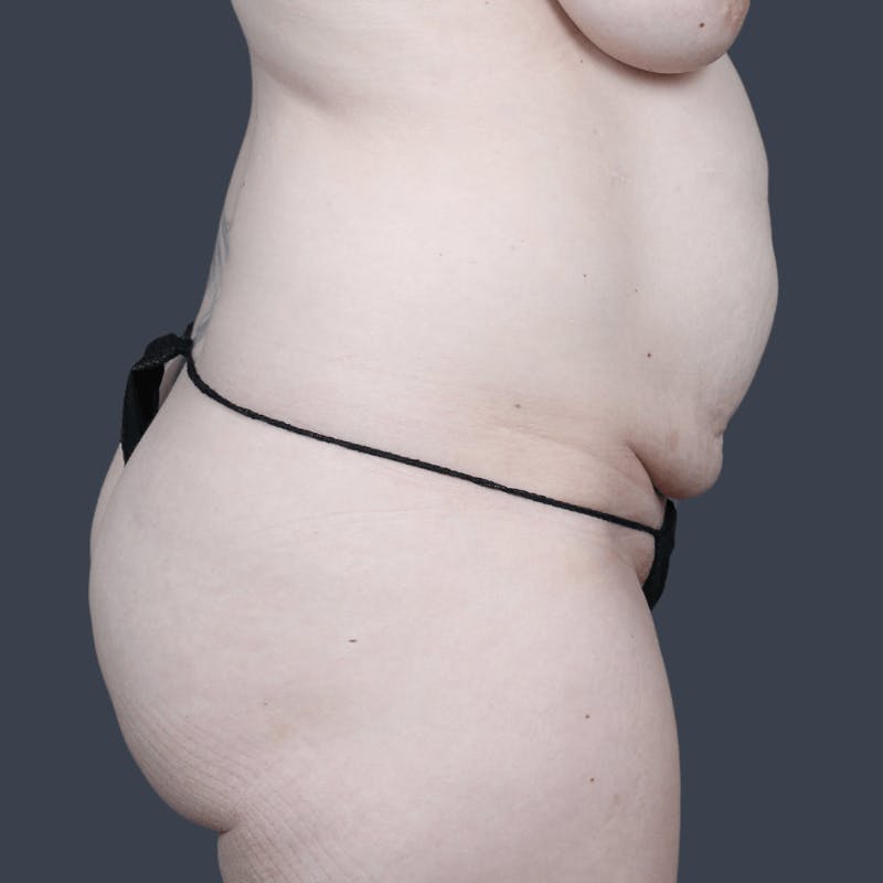 Abdominoplasty / Tummy Tuck Before & After Gallery - Patient 215261 - Image 5