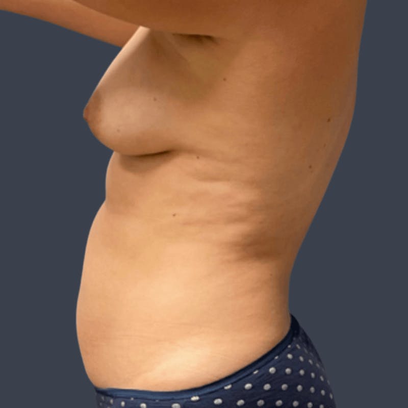 Liposuction Before & After Gallery - Patient 238493 - Image 5