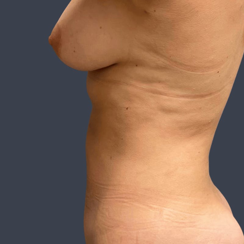 Liposuction Before & After Gallery - Patient 238493 - Image 6