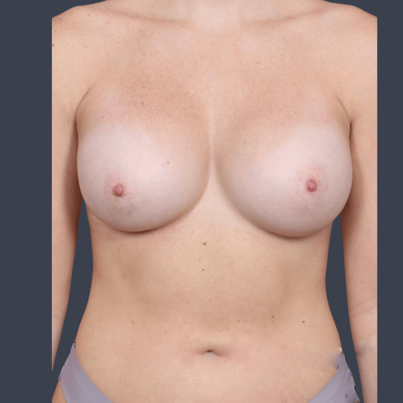 Breast Augmentation Before & After Gallery - Patient 433130 - Image 2