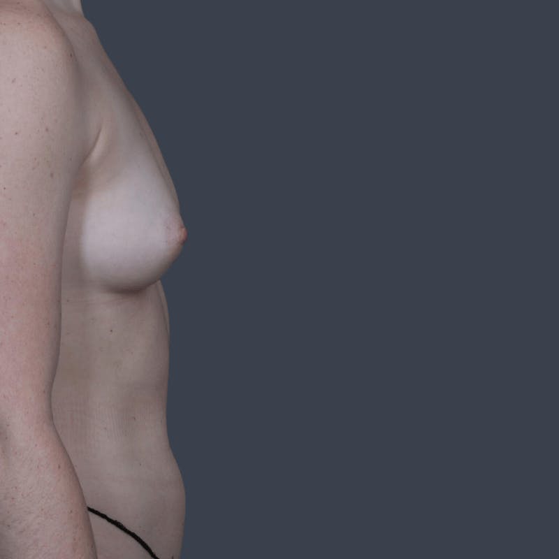 Breast Augmentation Before & After Gallery - Patient 433130 - Image 5
