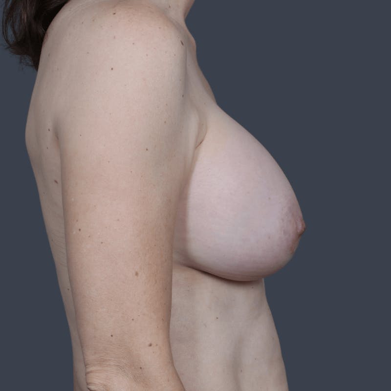 Breast Augmentation Before & After Gallery - Patient 399096 - Image 6