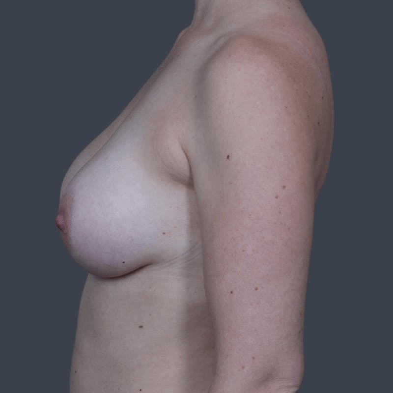 Breast Augmentation Before & After Gallery - Patient 638621 - Image 6