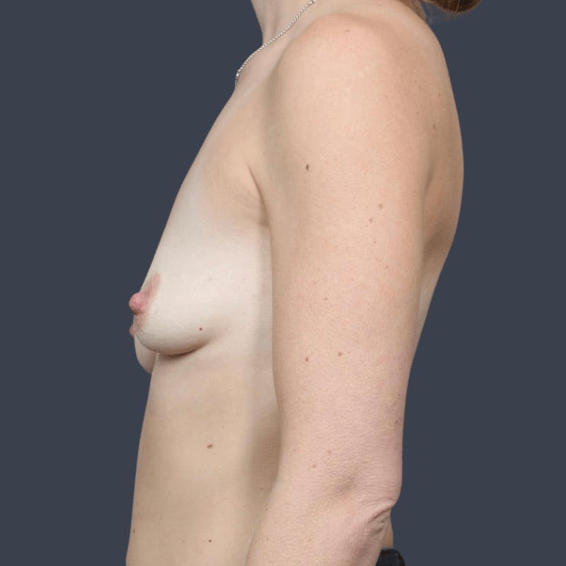 Breast Augmentation Before & After Gallery - Patient 638621 - Image 5