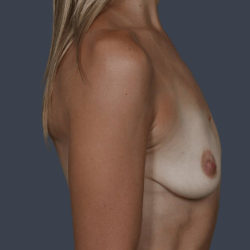 Breast Augmentation Before & After Gallery - Patient 407411 - Image 5