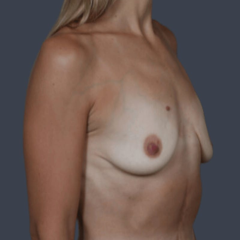 Breast Augmentation Before & After Gallery - Patient 407411 - Image 3